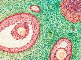 Is Polycystic Ovary Syndrome Actually a Brain Condition?